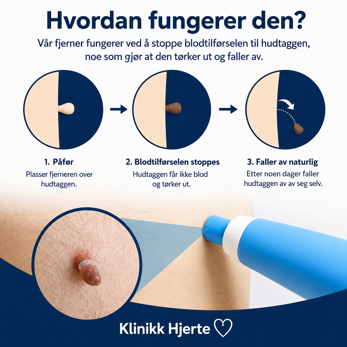 Hudfligfjerner til hjemmebrug – komplet sæt til målrettet påføring